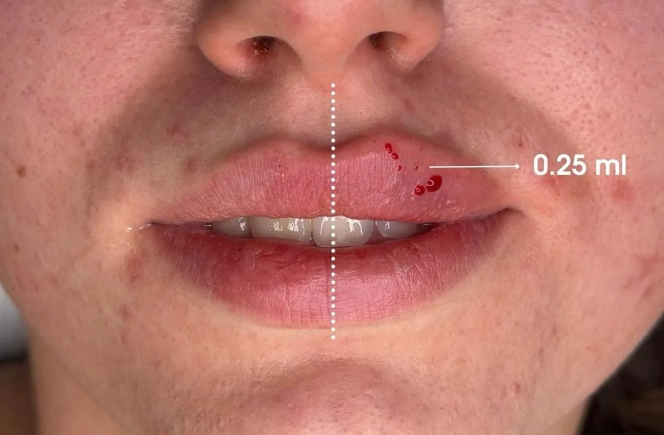 Avant Traitement Lèvres Milli Face (0.25ml)