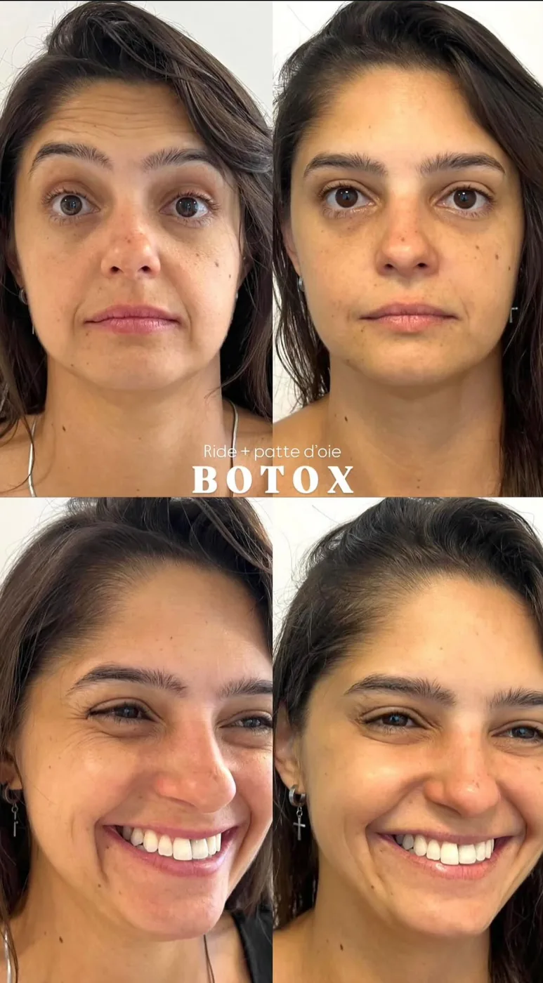Instagram Milli Face Botox