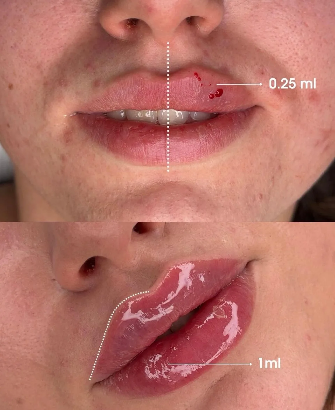 Démonstration Clinique Demi-Lèvre 0.25 ml vs 1 ml Avant Après