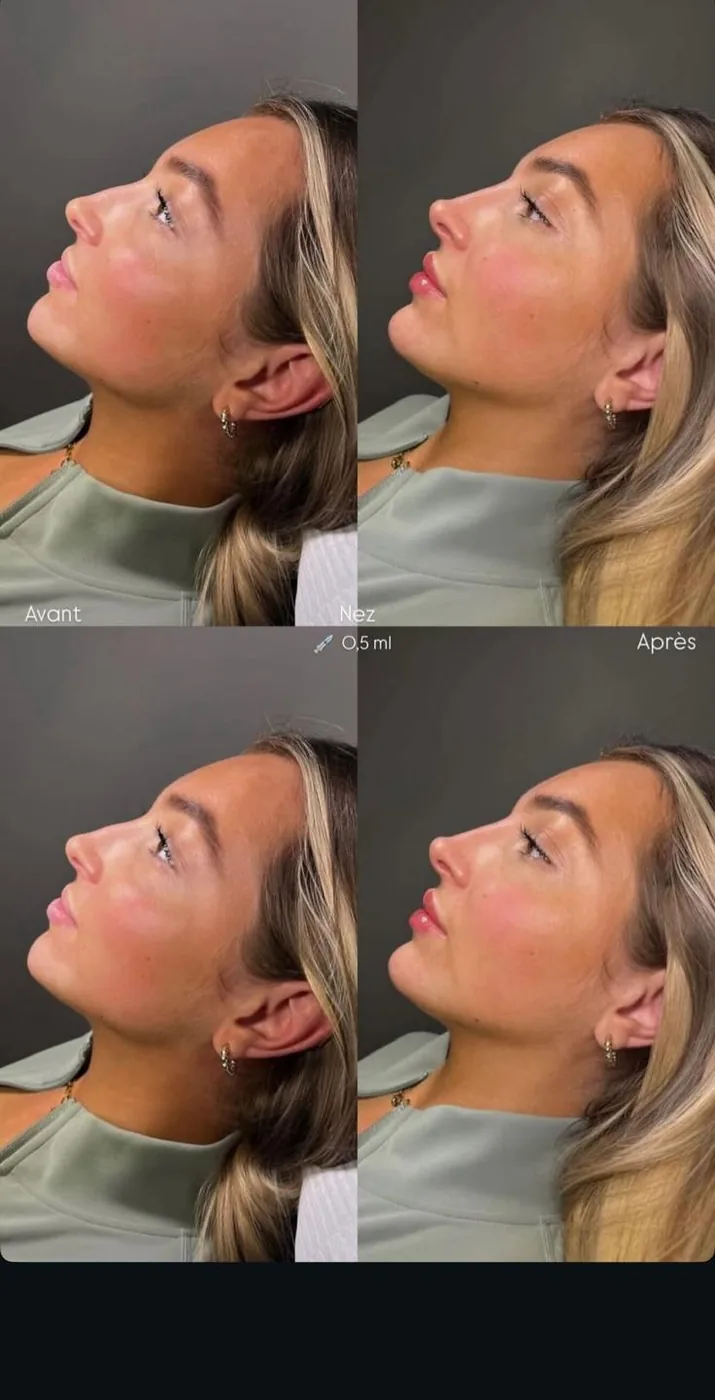 Barbie Nose Rhinofiller 0.5ml Profil Avant Après Bruxelles