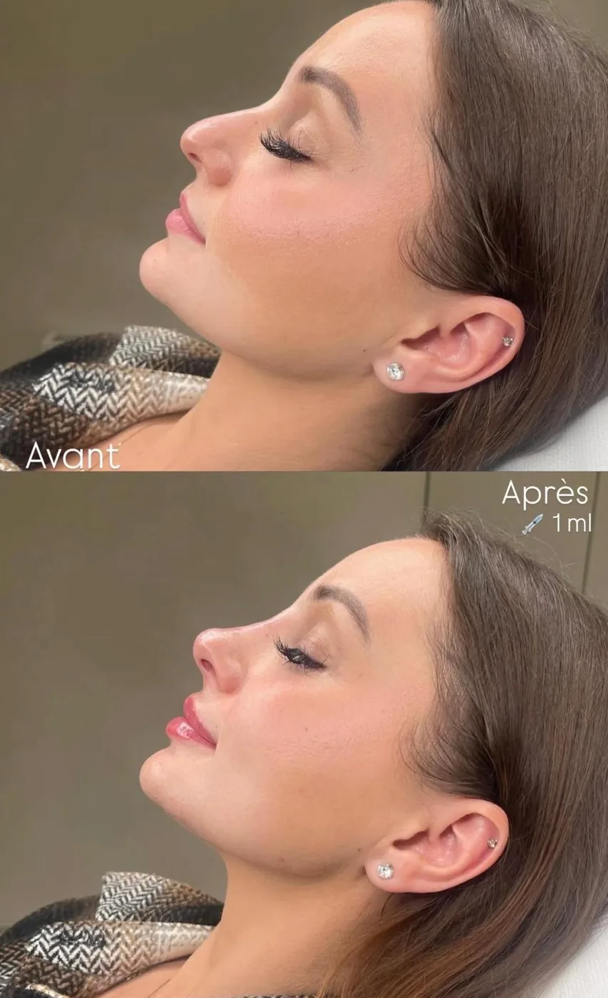 Barbie Nose Rhinoplastie Médicale 1 ml Avant Après