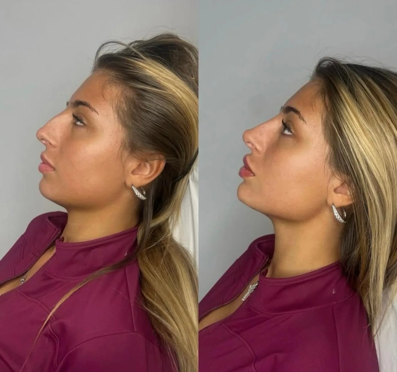 Barbie Nose Profil Avant Après Direct