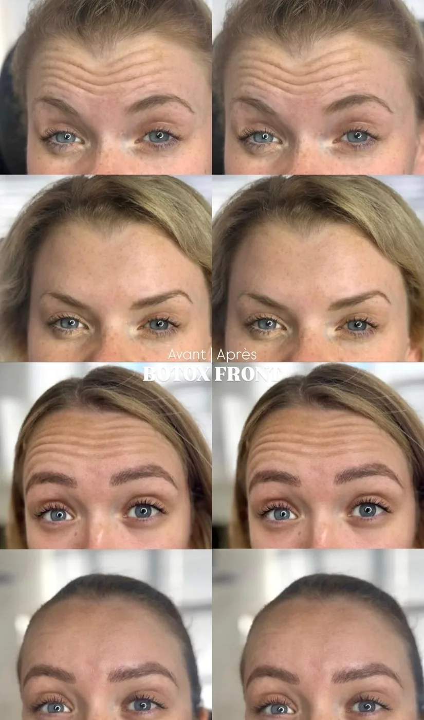 Botox Lissage Front 4 Expressions Avant Après Bruxelles