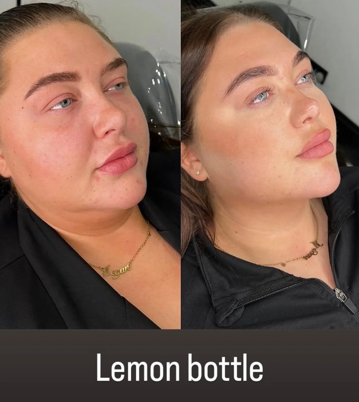 Lemon Bottle Double Menton Avant Après Bruxelles