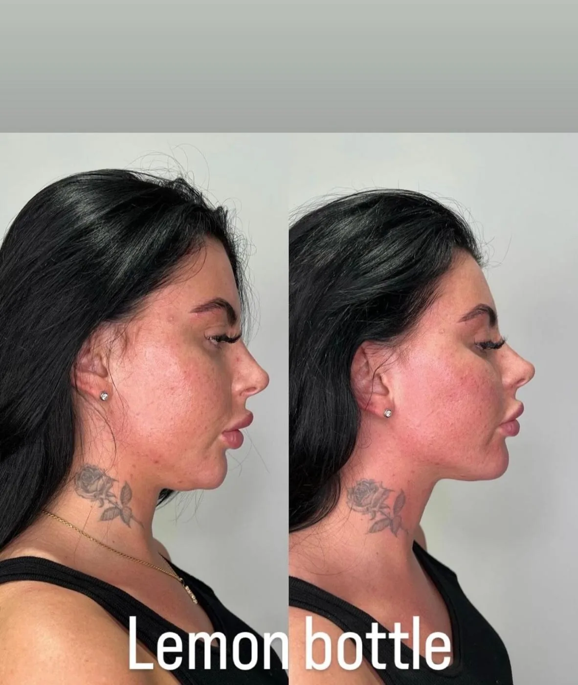 Lemon Bottle Jawline Profil Avant Après