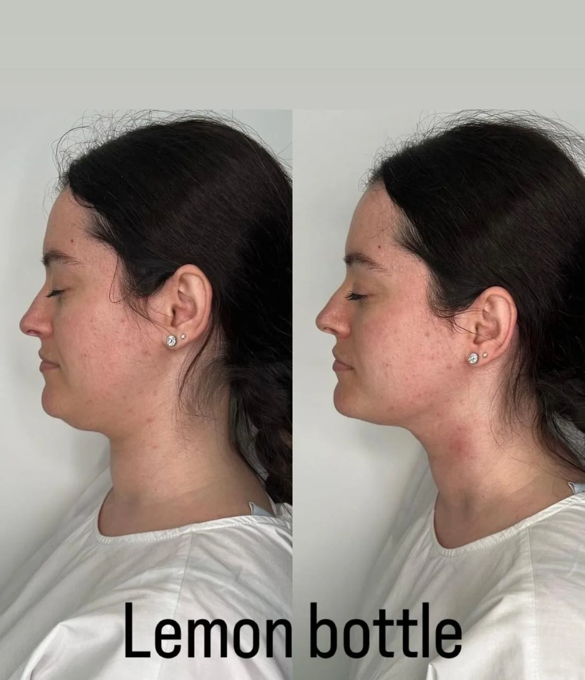 Lemon Bottle Ovale Visage Avant Après