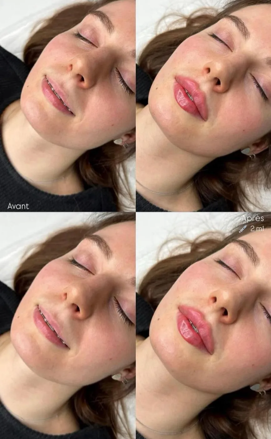 Injections Lèvres 2 ml Avant Après Bruxelles