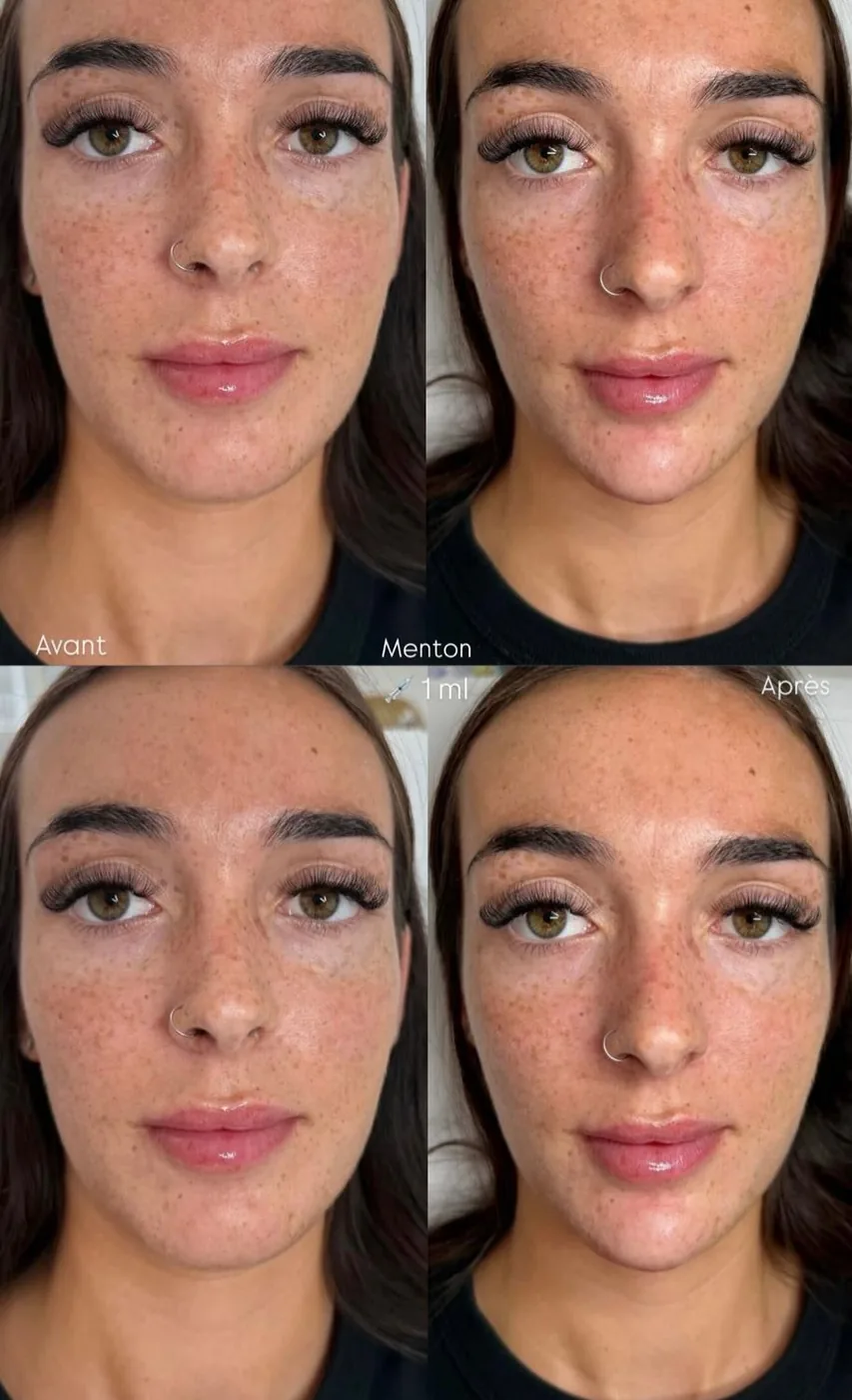Menton 1 ml Allongement Avant Après