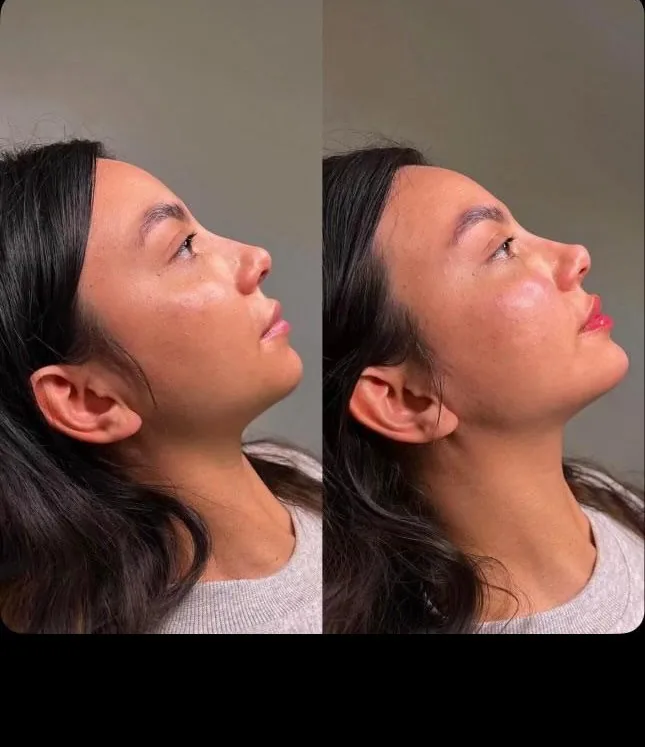 Profiloplastie Rhinofiller Avant Après