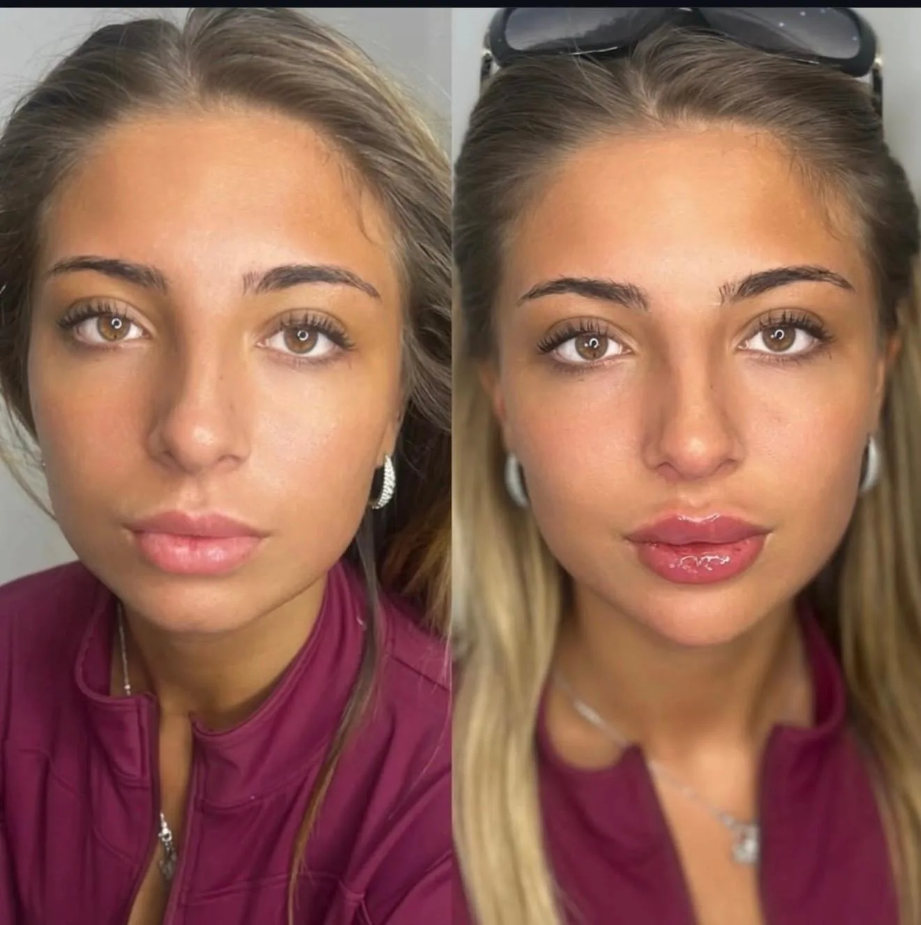 Russian Lips Visage Complet Avant Après Bruxelles