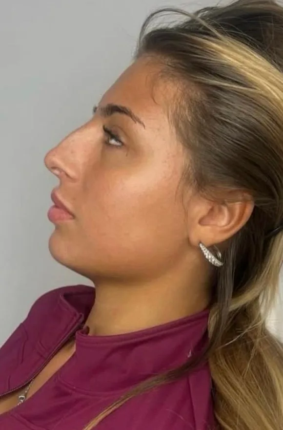 Avant Barbie Nose Rhinofiller Bruxelles